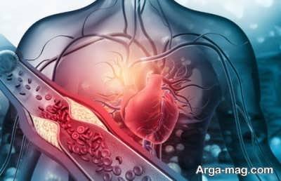 راه های درمان آترواسکلروز