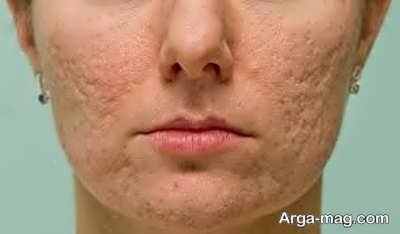 کاربرد لیزر اربیوم