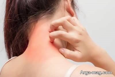 آلرژی به بدلیجات