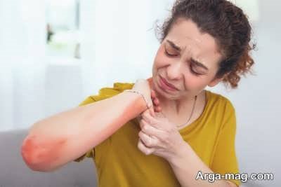 آلرژی به بدلیجات