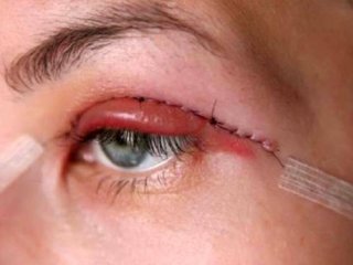 مراقبتهای بعد از جراحی پلک