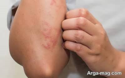 عوارض جانبی پورفیری