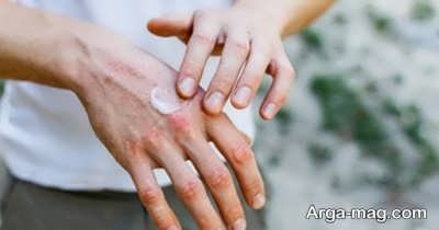 چطور با حساسیت پوست دست به مایع ظرفشویی مقابله کنیم؟