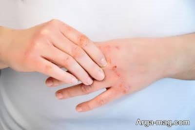 مشکلات پوستی  که مایع ظرفشویی ایجاد می کند چیست؟ 