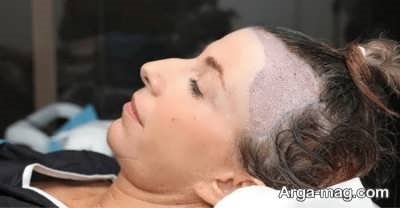 کاشت مو در زنان برای چه کسانی مناسب است؟