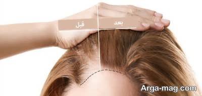 کاشت مو برای خانم ها