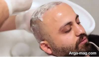 رنگ کردن مو بعد از کاشت