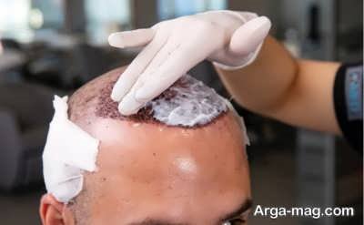 رنگ مو پس از کاشت