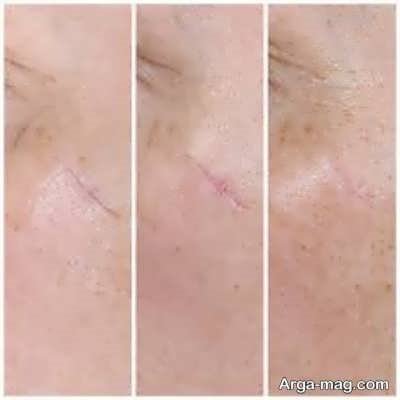 عارضه های برداشتن خال