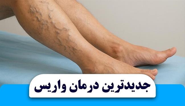 روش درمان واریس