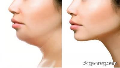 عمل ژینوپلاستی