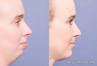 جراحی ژینوپلاستی