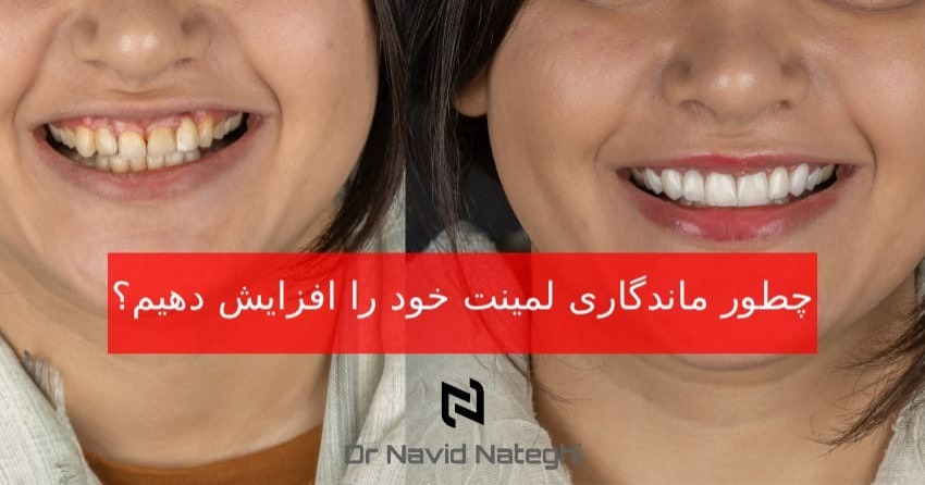 راز افزایش ماندگاری لمینت