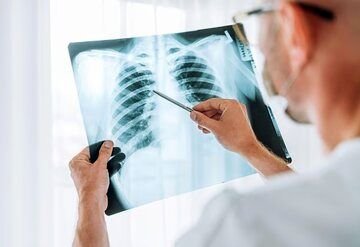 هشدار درباره سویه خطرناک ذات الریه/ چرا آنفلوآنزا گاهی کشنده می‌شود؟