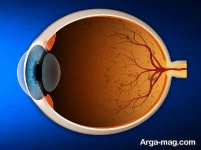 بیماری های شبکیه چشم