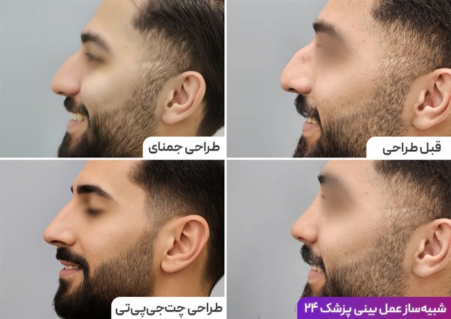 فرق طراحی بینی با انواع هوش مصنوعی و رینوبات پزشک 24